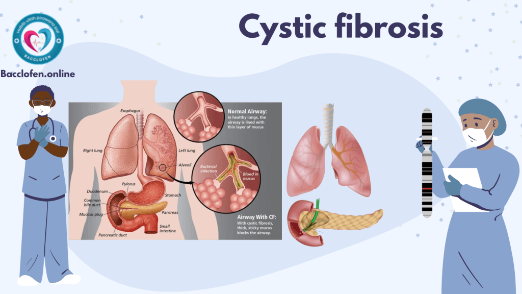 Cystic Fibrosis: Causes, Symptoms, Prevention, Diagnosis, and Treatment